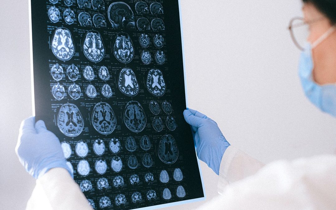 Understanding the Progression of Alzheimer’s Disease